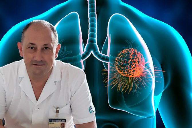 Skrining raka pluća