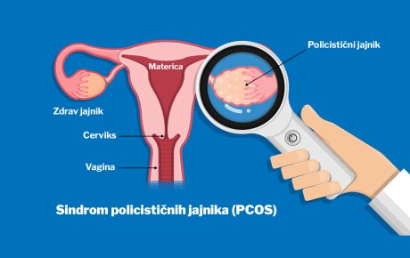 Sindrom plicističnih jajnika (PCOS)
