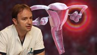 Sindrom policističnih jajnika izaziva sterilitet i može da ošteti srce, upozorava dr Radomir Aničić