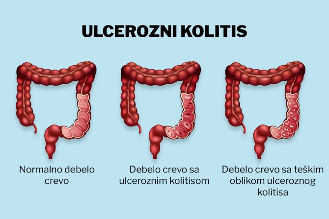 ulcerozni kolitis