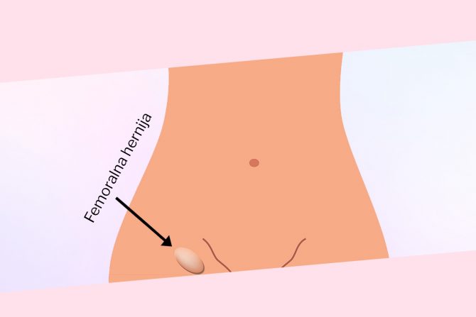 femoralna kila