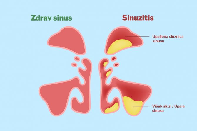 sinuzitis