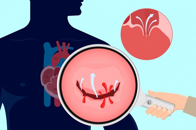 Reumatska bolest srca