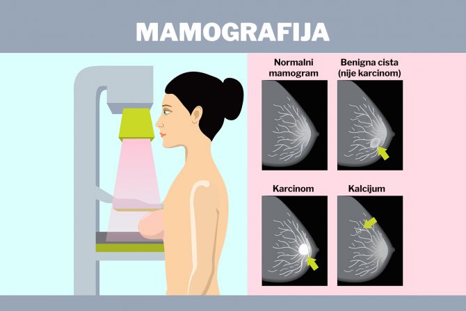 mamografija
