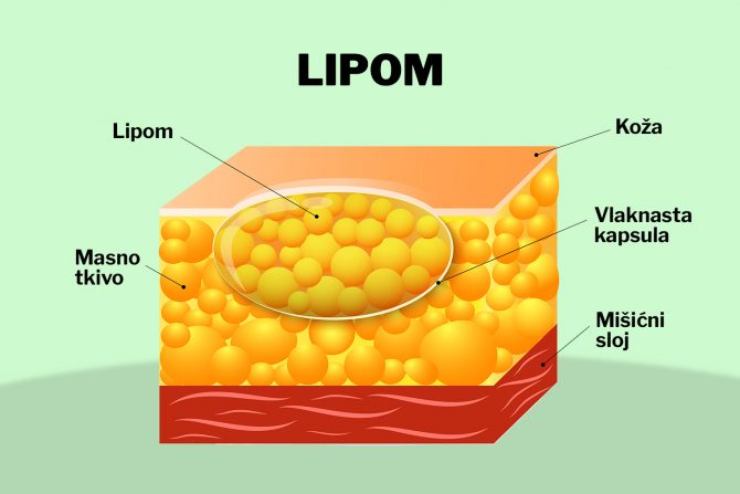 lipom