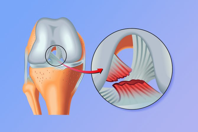 Povreda ligamenata u kolenu