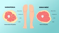 Sarkopenija kod starijih osoba povećava rizik od padova i preloma
