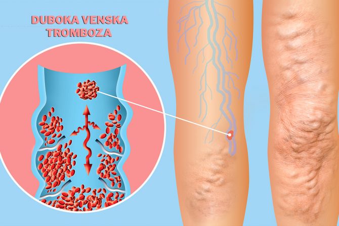duboka venska tromboza
