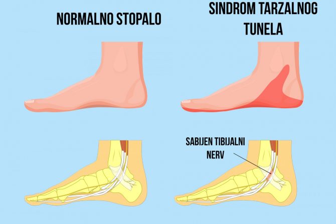 sindrom tarzalnog tunela