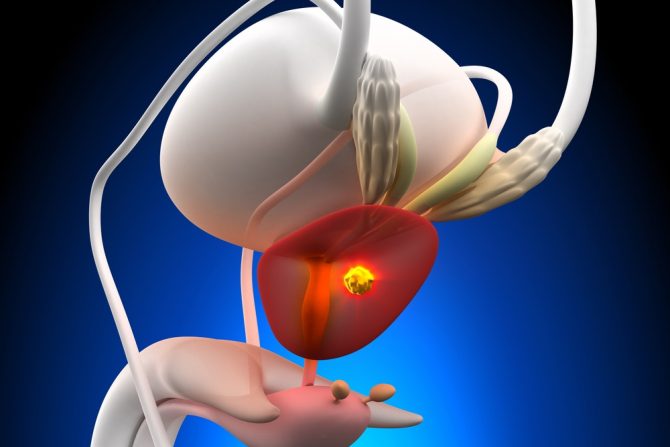 rak prostate