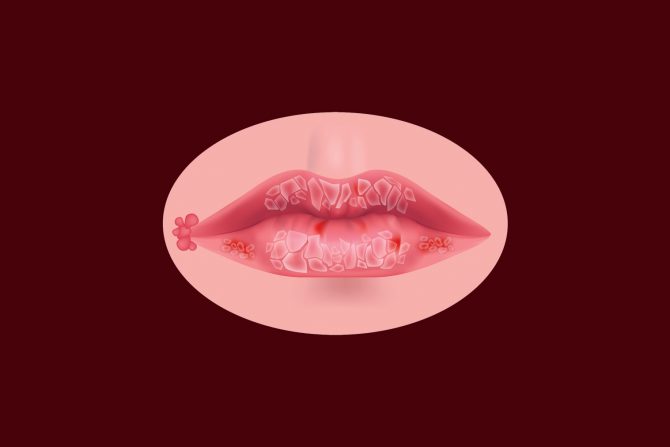 žvale nisu isto što i herpes