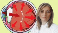 Visok očni pritisak utiče na nastanak glaukoma, a zatim i na gubitak vida, upozorava dr Sanja Kostić