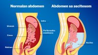 Ascites ili nakupljanje tečnosti u abdomenu može da ugrozi i disanje