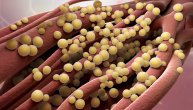 Impetigo je zarazno bakterijsko oboljenje kože, često kod dece