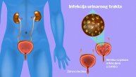 Infekcije urinarnog trakta vrlo su česte kod žena u menopauzi