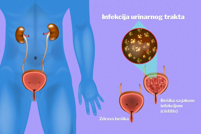 Infekcija urinarnog trakta