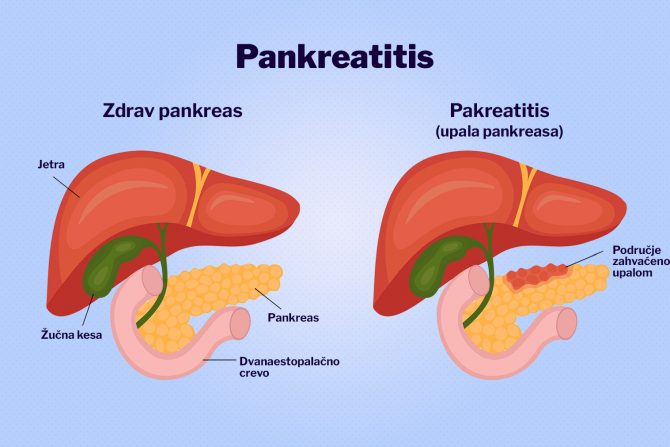 Pankreas pankreatitis