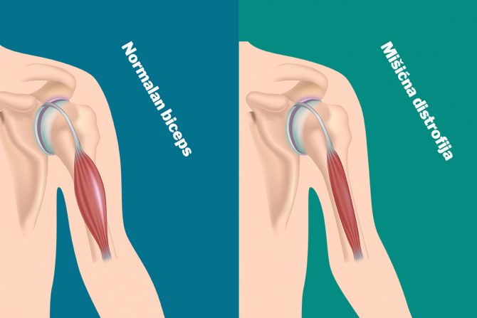 Mišićna distrofija
