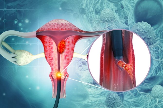 rak grlića materice