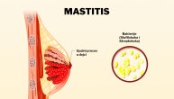 Mastitis je infekcija mlečnih kanala u dojci, a najčešće su ovih 5 vrsta