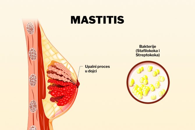 Mastitis