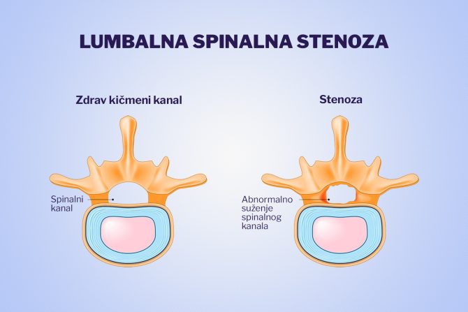 Lumbalna spinalna stenoza