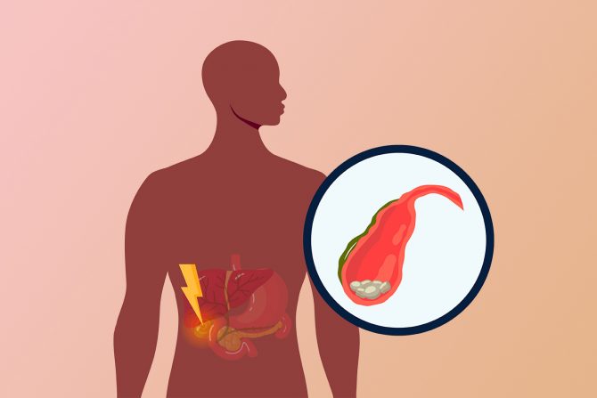 Žučne kolike, kamen u žučnoj kesi