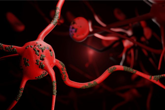 Guillain-Barre sindrom