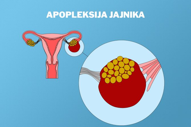 apopleksija jajnika