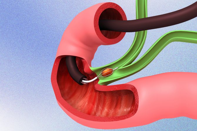 operacija žučne kese