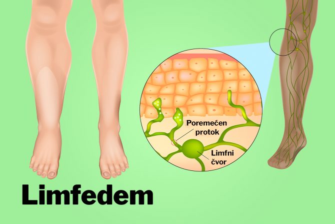 limfedem limfni sistem