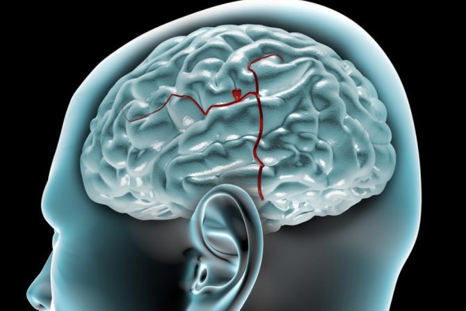 Cerebralne kavernozne malforacije