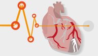 Hipertenzija u više od 50 odsto slučajeva izaziva infarkt ili šlog