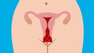 Vaginalno krvarenje u menopauzi može biti posledica dva teško izlečiva stanja