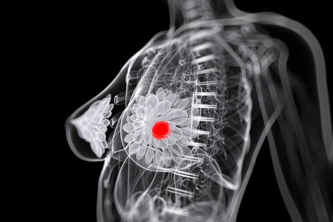 rak dojke. vakcina za agresivan rak dojke