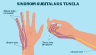 Sindrom kubitalnog tunela posledica je pritiska nerva u laktu