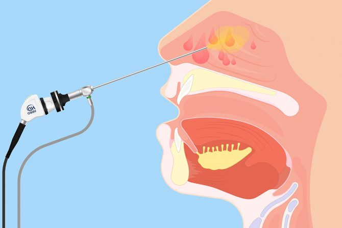 Endoskopska operacija sinusa