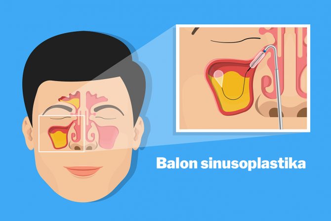 Balon sinusoplastika
