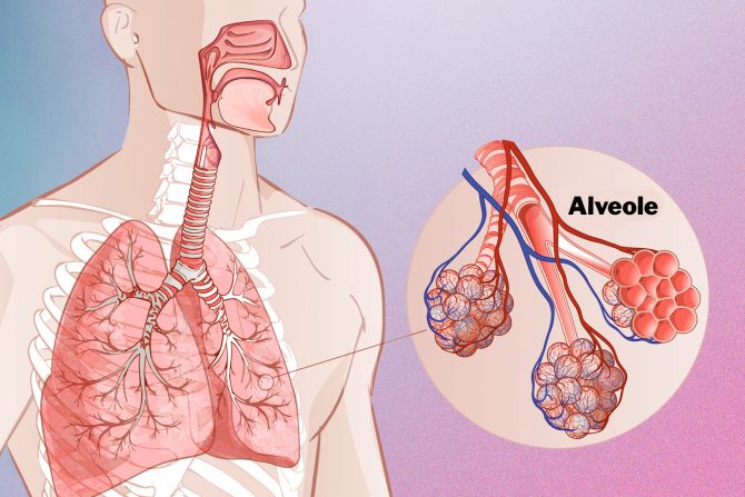 Paraseptalni emfizem pluća