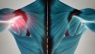 Upala mišića može da bude jaka i bolna – a šta je najbolji lek za ovo stanje