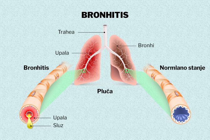 Bronhitis