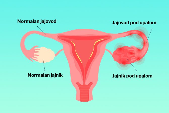 Upala jajnika