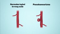 Pseudoaneurizma ili prođe sama od sebe ili se završi srčanim udarom, kako je prepoznati