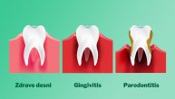 Zapaljenje desni često je bolno stanje i nije uvek posledica loše higijene