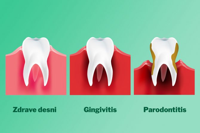 gingivitis