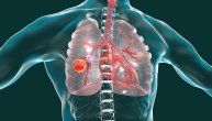 Tri neobična simptoma raka pluća koji na prvi pogled nemaju veze sa ovom bolešću