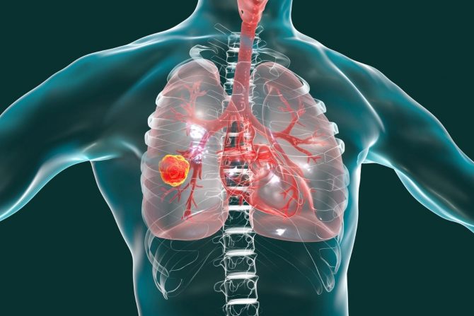 rak pluća