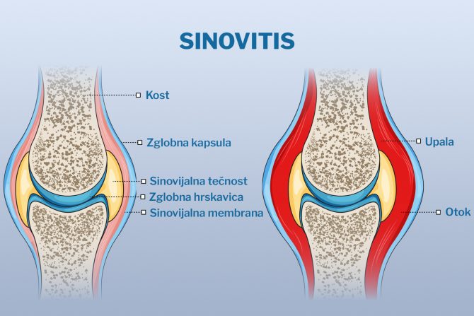 sinovitis