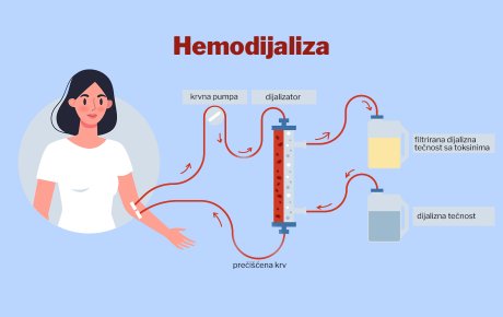 Hemodijaliza