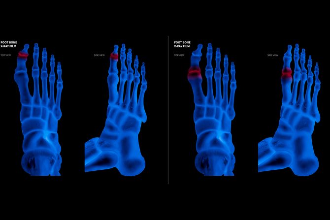 Prelom prsta na nozi